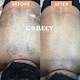 808nm diode laser hair removal machine